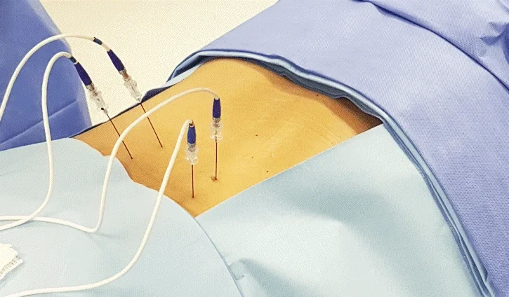 Procedimento de rizotomia por radiofrequência para o tratamento de dores crônicas na coluna e nervos, realizado pela Dra. Natally Santiago em São Paulo.