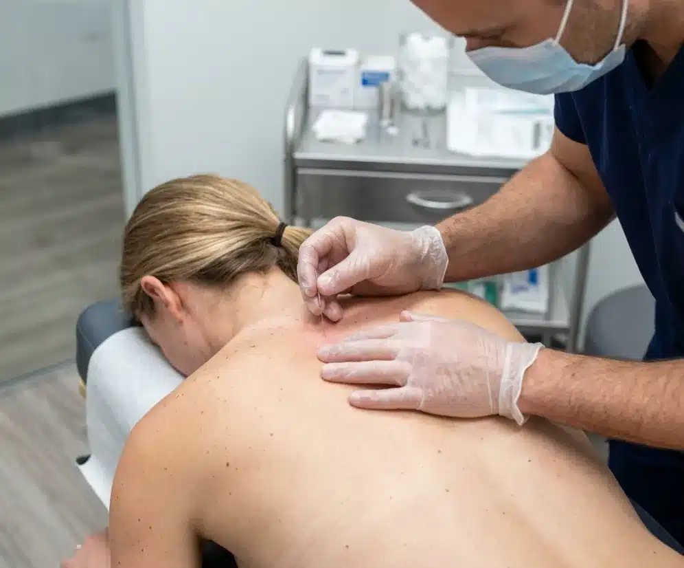 Ilustração demonstrando a técnica de agulhamento seco (dry needling) sendo aplicada em pontos-gatilho para o tratamento e alívio da síndrome dolorosa miofascial.